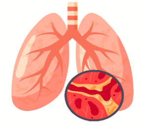 What Causes Bronchitis? Silent Acid Reflux! - Dr. Jamie Koufman